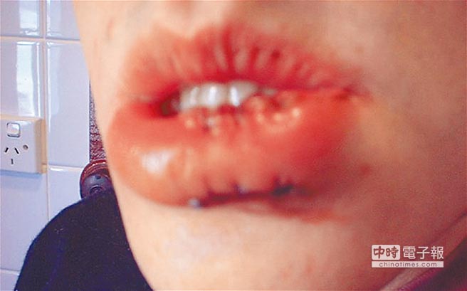 ↑史上第一張「selfie」（自拍照）。2002年澳洲男子喝醉，不慎摔傷嘴唇，他將自拍照片上傳網站。（英國每日電訊報網站）